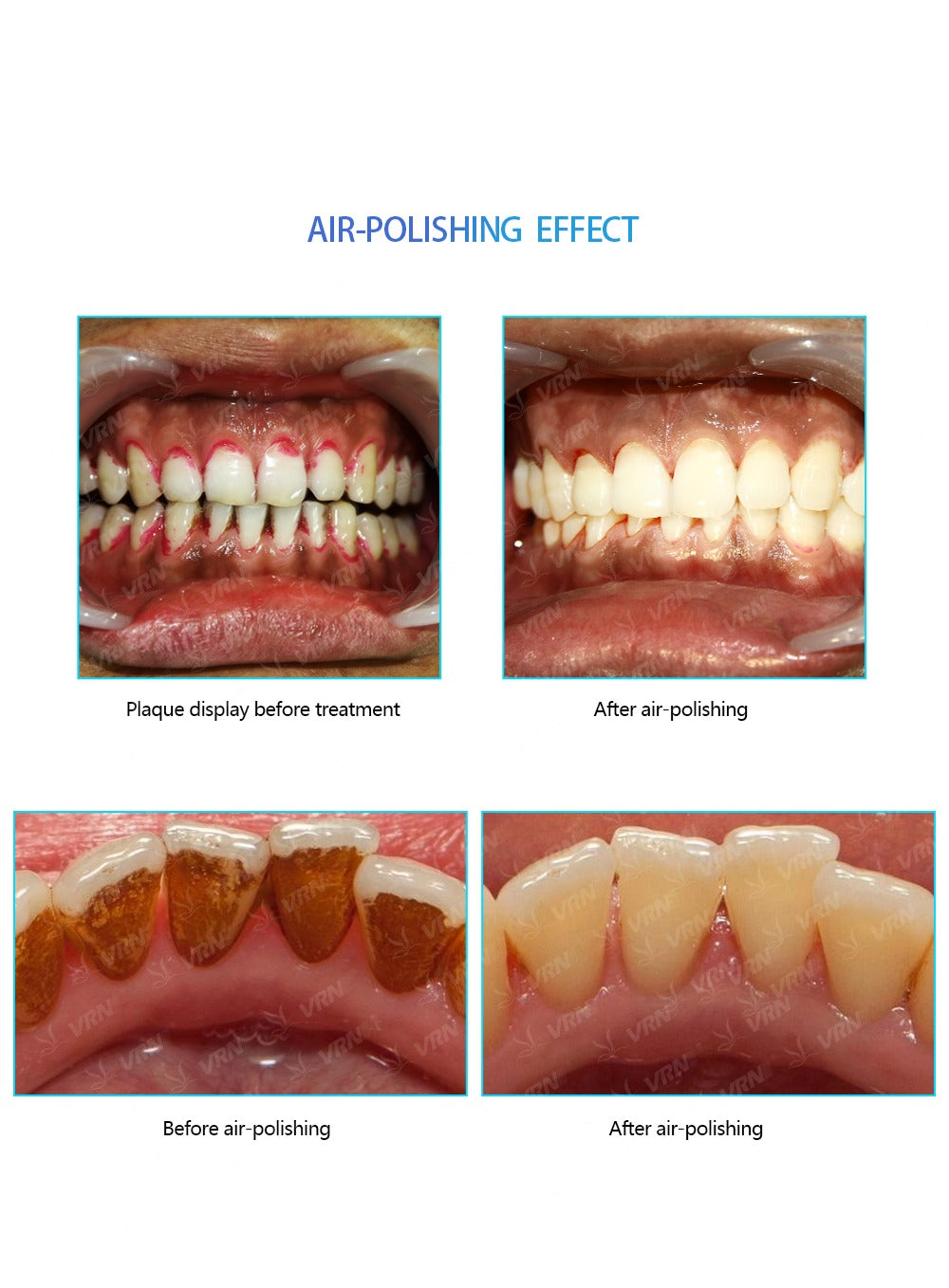 Pulidor de aire dental